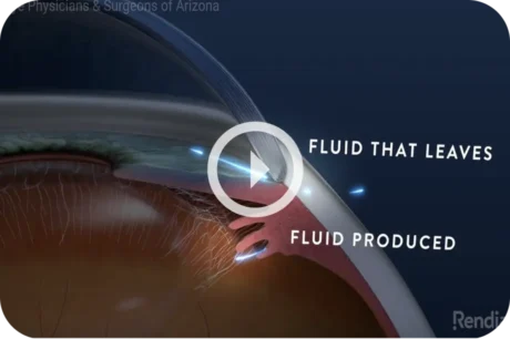 glaucoma-video-thumb